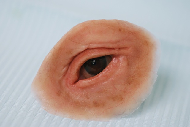Orbital Prosthesis