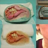 Prosthetics