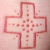 Cross skin peeling