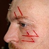 Facial skin peeling