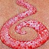 Skin peeling