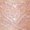 Heart Key scarification