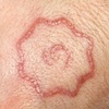 Borneo roses inspired scarification