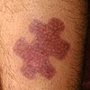 Puzzle piece skin peeling
