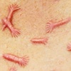 Dadelion scarification