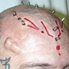 Facial skin peeling