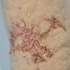 Scarred forearm (close-up)