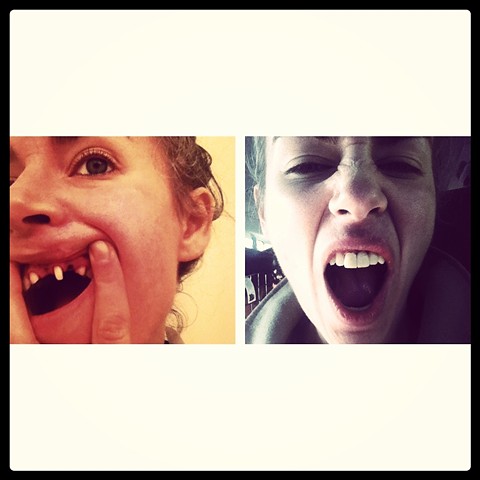 My mouth prepped for crowns
