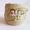 Retainer in Cast Plaster Mold 
