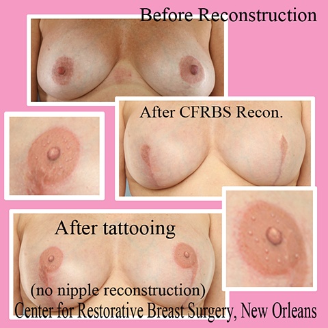 3-D nipple tattoo