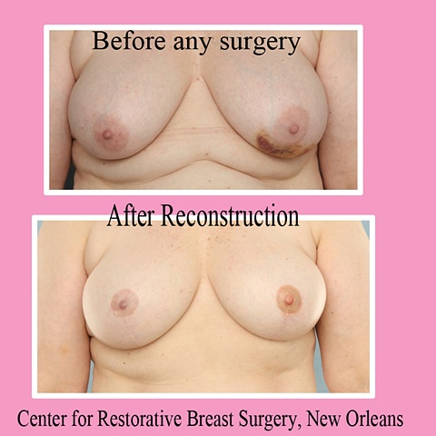 nipple areola tattoo (unilateral)
