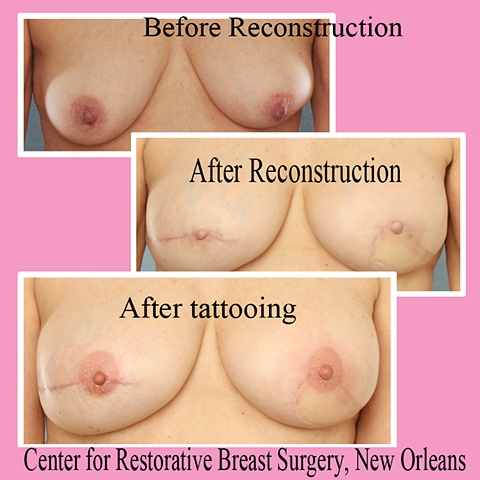 nipple areola tattoo