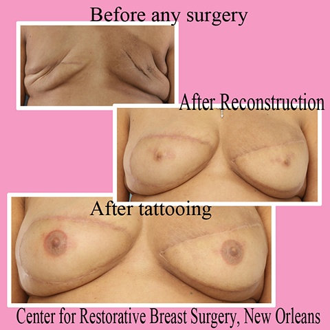 nipple areola tattoo