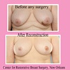 nipple areola tattoo (unilateral)
