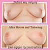 3-D nipple areola tattoo