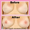 3-D nipple tattoo