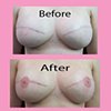 3-D nipple tattoos