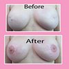 3-D nipple tattoos