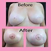 3-D nipple tattoos
