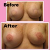3-D nipple tattoo 