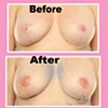 nipple tattoo revision