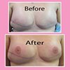 3-D nipple tattoos
