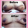 nipple tattoo (unilateral)