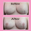 3-D nipple tattoos