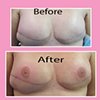 3-D nipple tattoos