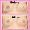 nipple tattoo (unilateral)