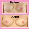 3-D nipple areola tattoo