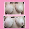 3-D nipple tattoos